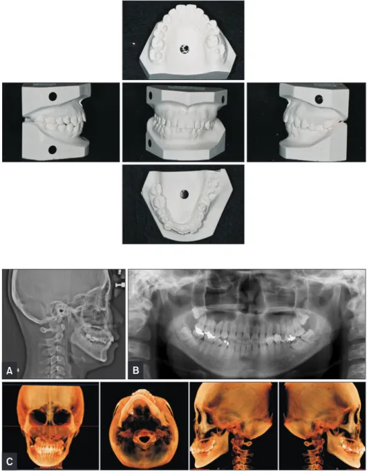 Figure 3. Pretreatment ra- ra-diographs.  A, Lateral  cepha-logram;  B, panoramic  ra-diograph; and C, cone-beam  com puted tomography images.