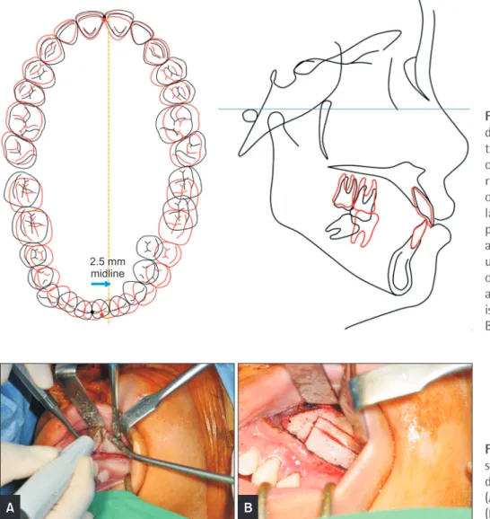 Figure 4. Cephalometric and  dental visual treatment  objec-tive (VTO): the posterior teeth  on the cephalometric VTO  represent the collapsed side  only (left)