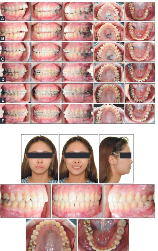 Figure 6. Treatment progres- progres-sion 2 weeks (A), 6 weeks (B),  10 weeks (C), 5 months (D), 11  months (E), and 16 months (F)  after posterior maxillary  seg-mental osteotomy.