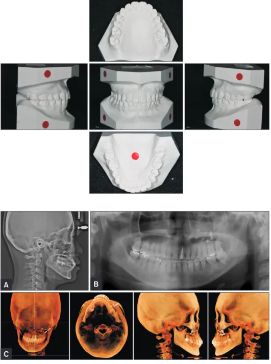 Figure 8. Post-treatment cast  models.