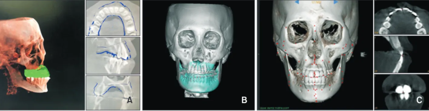 Figure 1. The process of merging between the scanned dentition and the three-dimensional cone-beam computed to- to-mography (3D-CBCT) image and landmark digitization