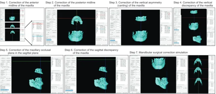 Figure 3. The step-by-step procedure of virtual surgical simulation. Step 1, Correction of the anterior midline of the  maxilla