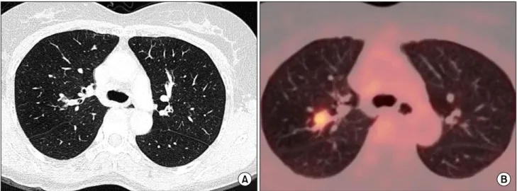 Fig. 1. (A) A chest CT scan showed a nodule obstructing the posterior bronchus in the RUL