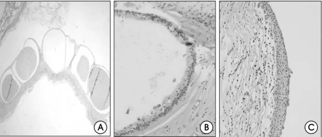 Fig.  3.  Pathologic  findings.  A.  Submucosal  epithelial-lined  multiple  cysts,  B