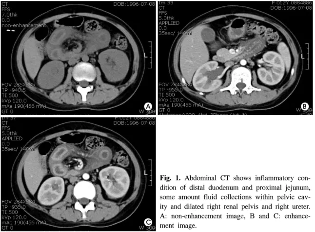 Fig.  1.  Abdominal  CT  shows  inflammatory  con- con-dition  of  distal  duodenum  and  proximal  jejunum,  some  amount  fluid  collections  within  pelvic   cav-ity  and  dilated  right  renal  pelvis  and  right  ureter.