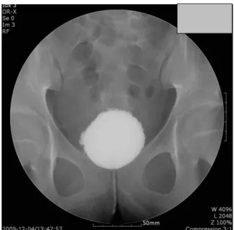 Fig.  5.  Voiding  cystourethrograpy  shows  contracted  bladder  and  no  vesicoureteral  reflux.