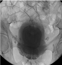 Fig.  1.  Initial  retrograde  cystography  shows  bilateral  high  grade  hydronephrosis    due  to  the  urinary  obst-  ruction  of  giant  bladder  stone.