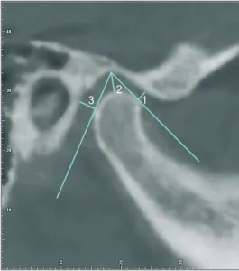 Figure 1. Arrangement of the left condyle’s long axis.