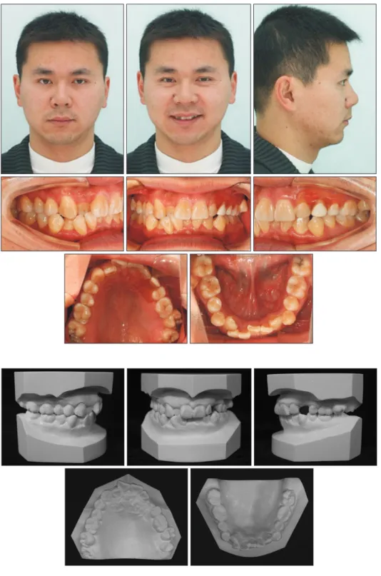 Figure 2. Pretreatment dental  casts.
