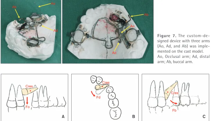 Figure 7. The custom-de- custom-de-signed device with three arms  (Ao, Ad, and Ab) was  imple-mented on the cast model