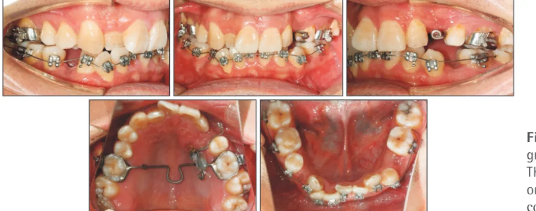 Figure 14. A helix was added to correct the scissor bite  of the maxillary left second molar and mandibular left  second molar.