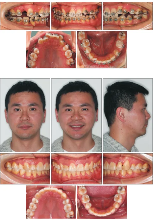 Figure 15. Intraoral photo- photo-graphs obtained at 22  mon-ths. The alignment and  level-ing on the maxillary arch have  commenced.