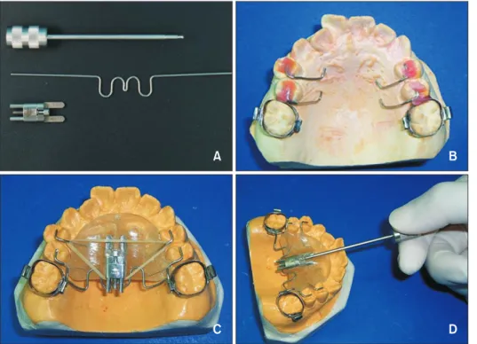 Figure 1. Structure of the  Frog appliance (FORESTADENT  Bernhard Förster GmbH,  Pfor-zh eim,  Germany)