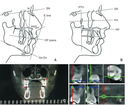 Figure 3. Cephalometric measurements performed in the study. A, B, Linear and angular measurements
