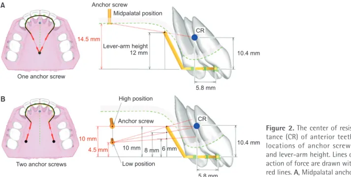 Figure 2A and 2B show the location of the CR of the  anterior teeth and the line of action of the force with  respect to the initial tooth position