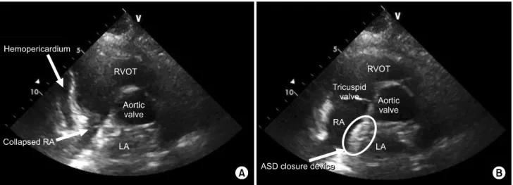Fig. 1. Computed tomography angiography showing no evidence  of acute aortic dissection or intramural hematoma