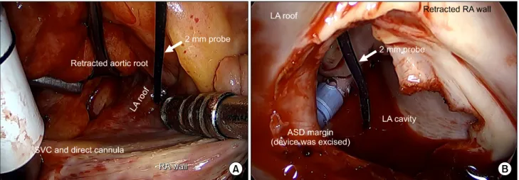 Fig. 3. Intraoperatively, a 2-mm probe (arrow) could pass through the LA roof perforation site (A)