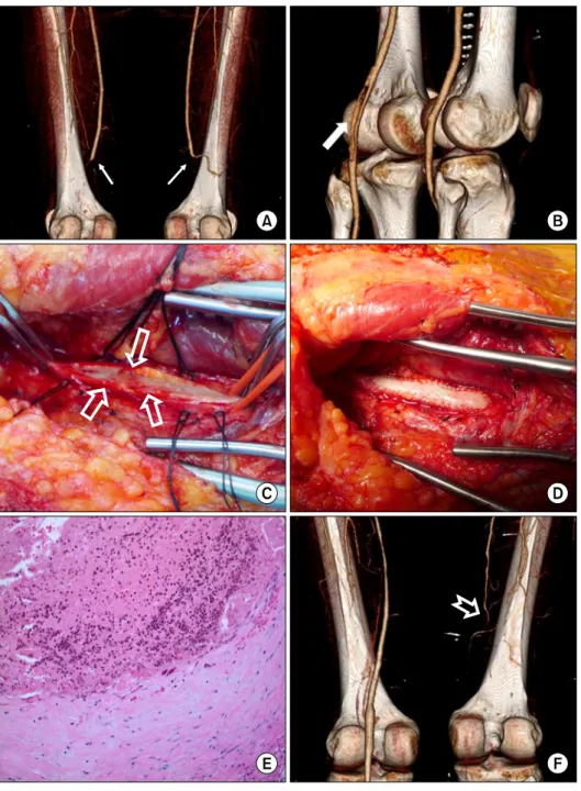 Fig. 2. (A) A preoperative CT angio- angio-gram shows total occlusion of both  PAs (line arrow)