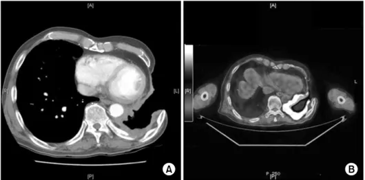 Fig. 2. (A) Chest computed tomography revealed progression of the extrathoracic extension of the enhancing soft-tissue lesion, including  rib invasion (black arrow) and particularly involving the neural foramen and the epidural space at the level of the th