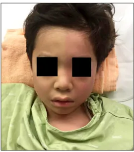 Fig. 2. Harlequin syndrome. Asymmetric flushing of the left face,  neck, and upper chest after surgery.