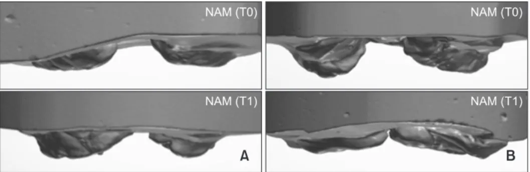 Figure 4. Vertical deviations after nasoalveolar molding (NAM) in two different representative cases with unilateral  cleft lip and palate