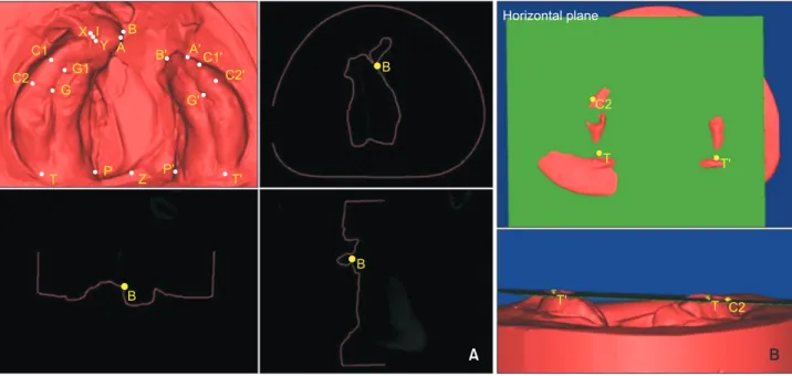 Figure 2. Alveolar segmenta- segmenta-tion for the measurement of  changes after nasoalveolar  molding in infants with  uni-lateral cleft lip and palate