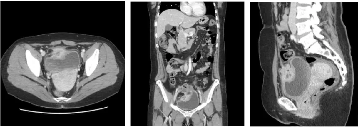 Fig.  1.  Ultrasonogrphy  of  bladder  shows  a  4.1×3.5cm  sized  mass  at  anterior  bladder  wall.