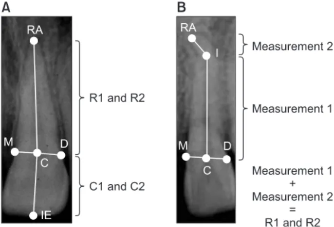 Figure 2. References to the measurement of external api- api-cal root resorption in rhomboid, triangular, pipette (A),  and dilacerated roots (B)