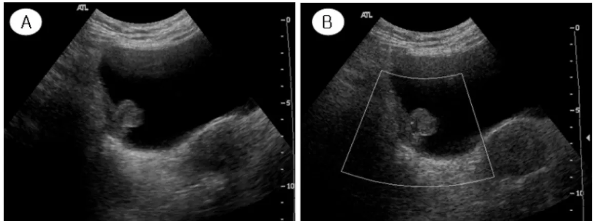 Fig.  2.  Pelvis  ultrasonography  shows  right  lateral  bladder  mass  with  vascularity  (A,  B).