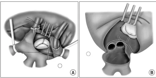 Fig. 1. Operative technique. (A) Right atrial procedure. (B) Left atrial  pro-cedure.