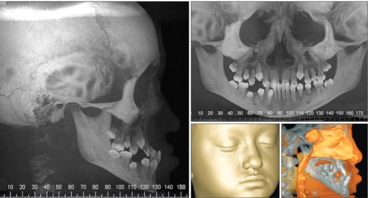 Figure 2. Pretreatment lateral cephalogram, panoramic radiograph, and cone-beam computed tomography images for a  young girl with severe Class III malocclusion due to maxillary hypoplasia.