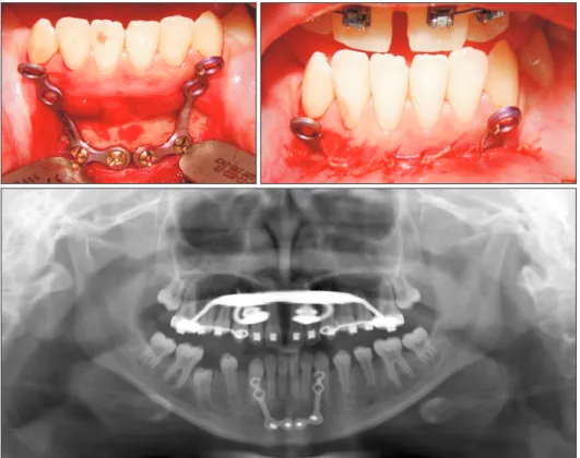 Figure 7. Fixation of intermaxillary elastics extending  from the mandibular miniplates to the hybrid hyrax  ap-pliance and from the mandibular to the maxillary  brack-ets in a young girl with severe Class III malocclusion due  to maxillary hypoplasia.
