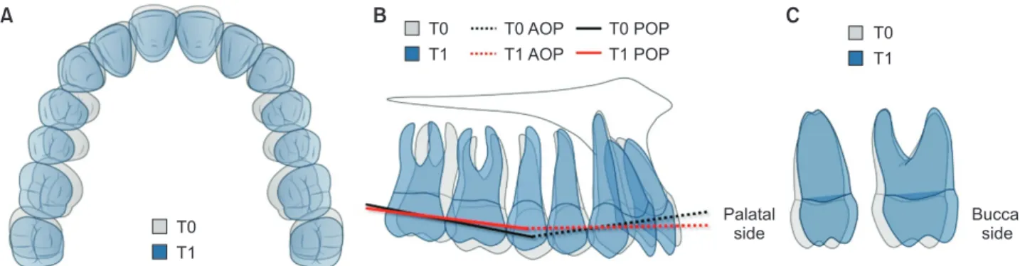 Table 2. Three-dimensional angular displacement of teeth and the occlusal plane Variable T0 T1 T0–T1 p-value Inclination (°)    U1 83.69 ± 5.01 86.01 ± 7.23 −2.31 ± 5.70   0.085    U3 101.23 ± 5.66 101.44 ± 2.96 −0.22 ± 5.63   0.864    U5 111.73 ± 6.88 107