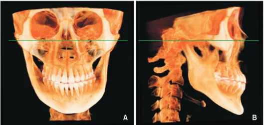Figure 2. Midpalatal suture opening width in periapical  radiographic images (A) at T0 and (B) at T1 in separation  and at T2 in non-separation cases