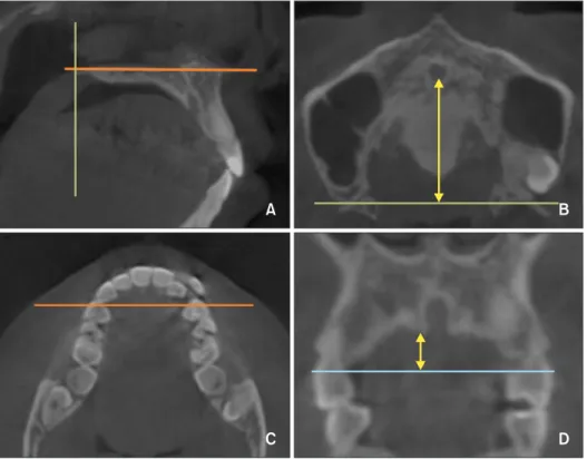 Figure 5. Schematic images of midpalatal suture maturation stages by midpalatal suture morphology, in accordance  with the results reported by Angelieri et al