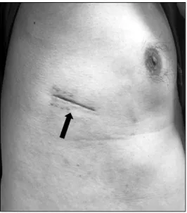 Fig. 1. Skin incision 1 month after the operation (arrow).