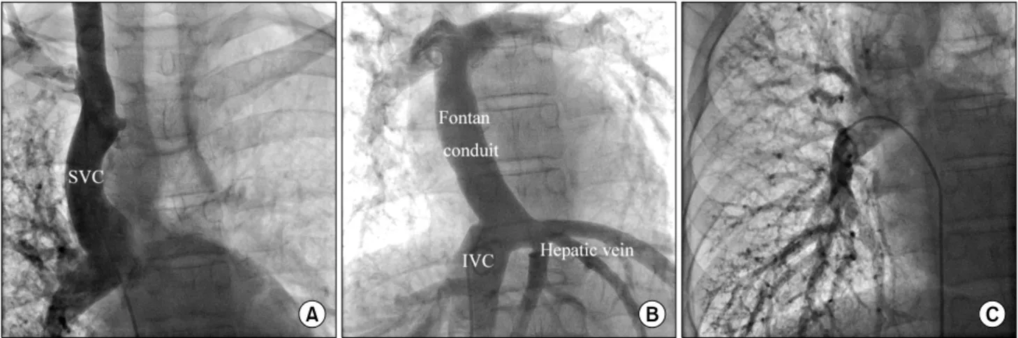 Fig. 1. A selective angiogram showing that (A) the right lung received almost all blood flow from the SVC, (B) while the blood from the  IVC mainly flowed to the left lung