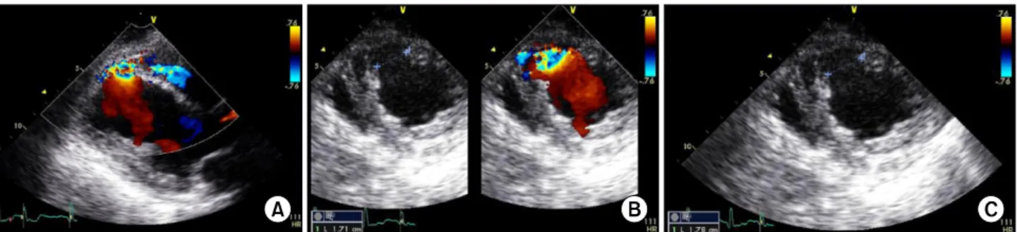 Fig. 1. 2D echocardiograms. (A) 2D color Doppler image in the parasternal long-axis view