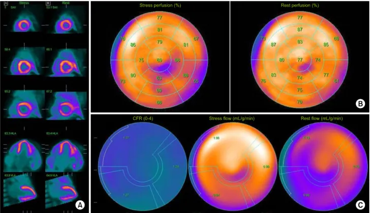 Fig. 2.  13 N-ammonia positron emission tomography myocardial perfusion imaging demonstrating a global defect of the left ventricle (A, B)  and the decrease of CFR (C)