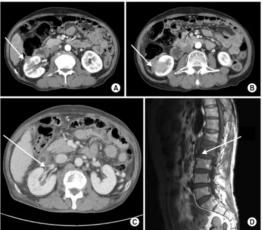 Fig. 1. An abdomino-pelvic computed  tomography scan showed two exophytic  renal masses—1.5 cm and 3.7 cm in size  (A, B)—with renal vein thrombosis (C,  arrow)
