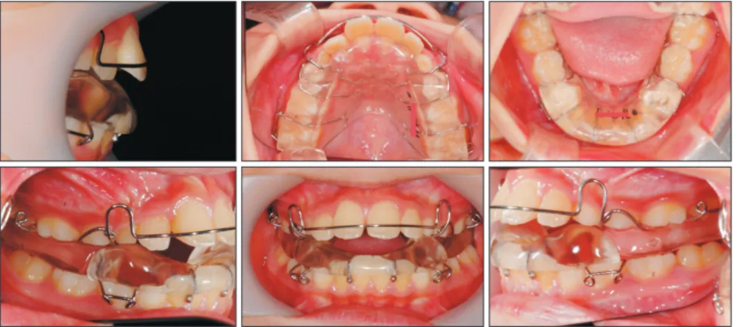 Figure 1. The Class II Twin- Twin-block appliance used in this  study.