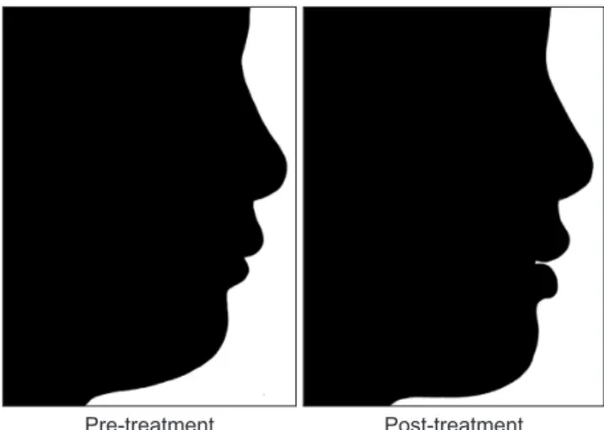 Table 4 presents the cephalometric treatment changes; 