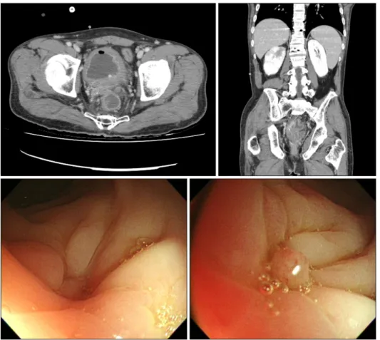 Fig. 4. Follow-up computed tomography  and sigmoidoscopy on the 20th day  showed an improved state of abscess  cavity and rectal fistula.