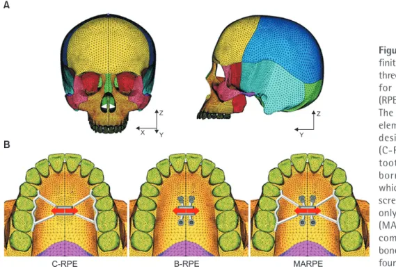 Figure 1. The model used for  finite element analysis and the  three different appliances used  for rapid palatal expansion  (RPE) in the present study