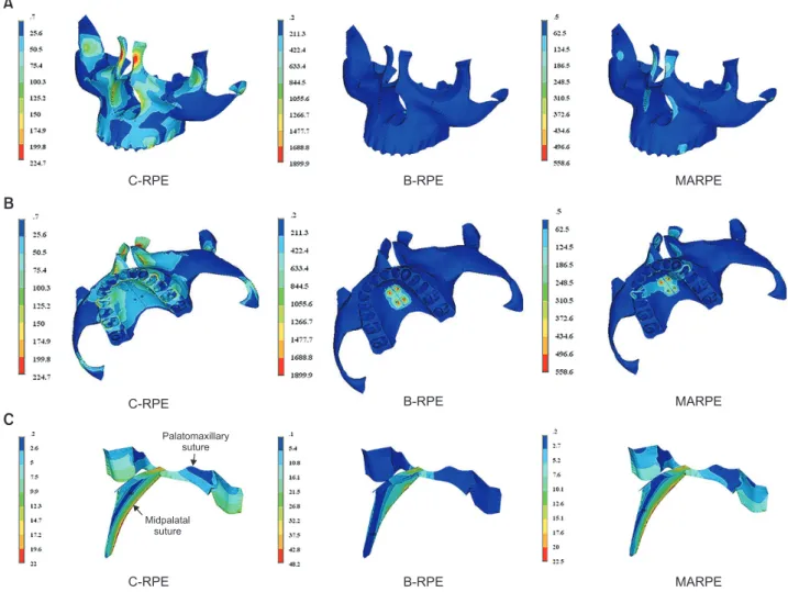 Figure 2. The finite element model showing the von Mises stress distribution over the circumaxillary structures (g/mm 2 )  caused by rapid palatal expansion (RPE) using three different appliances