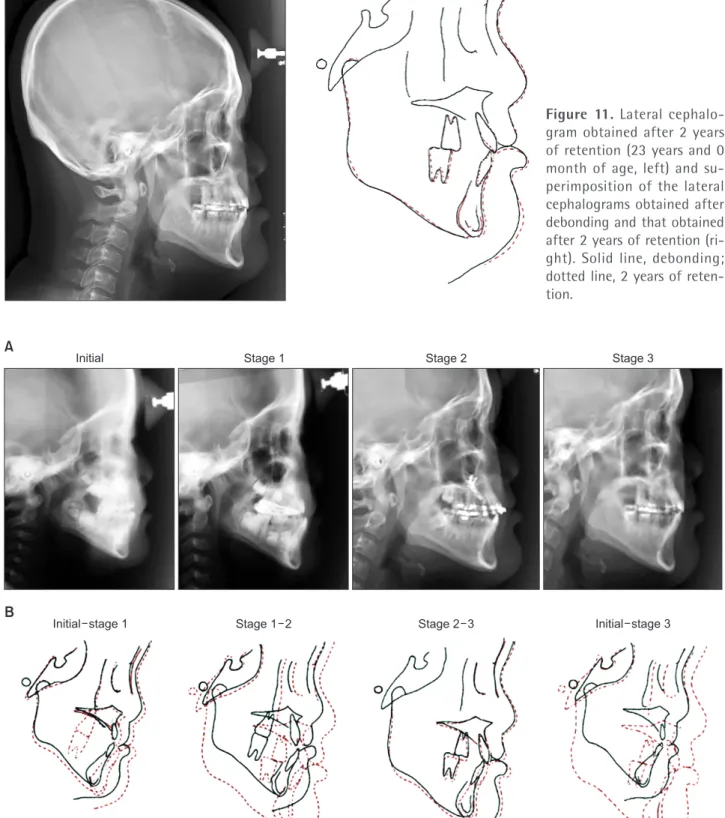 Figure 11. Lateral cephalo- cephalo-gram obtained after 2 years  of retention (23 years and 0  month of age, left) and  su-perimposition of the lateral  cephalograms obtained after  debonding and that obtained  after 2 years of retention  (ri-ght)