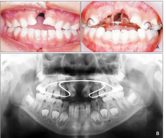 Figure 4. Maxillary expansion  and iliac bone grafting (IBG). 