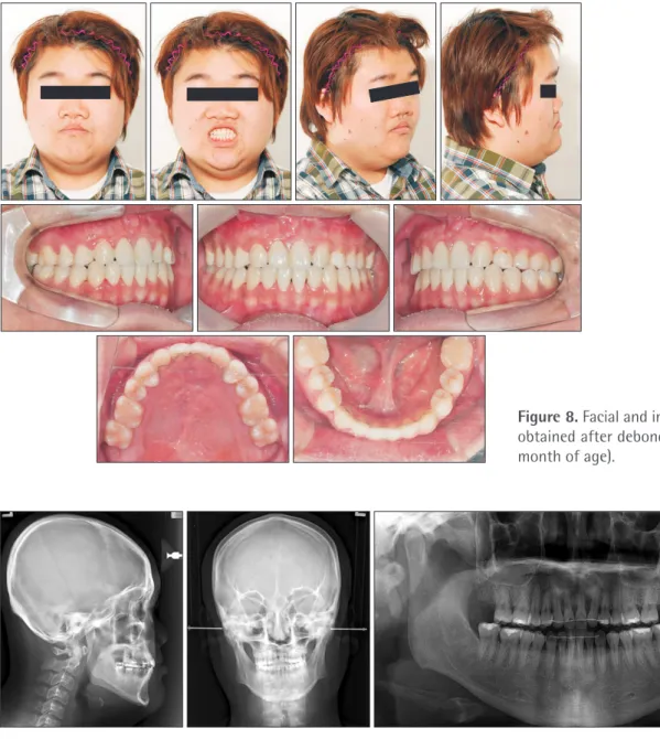 Figure 9. Lateral cephalogram, postero-anterior cephalogram, and a panoramic radiograph obtained after debonding (21  years and 0 month of age).