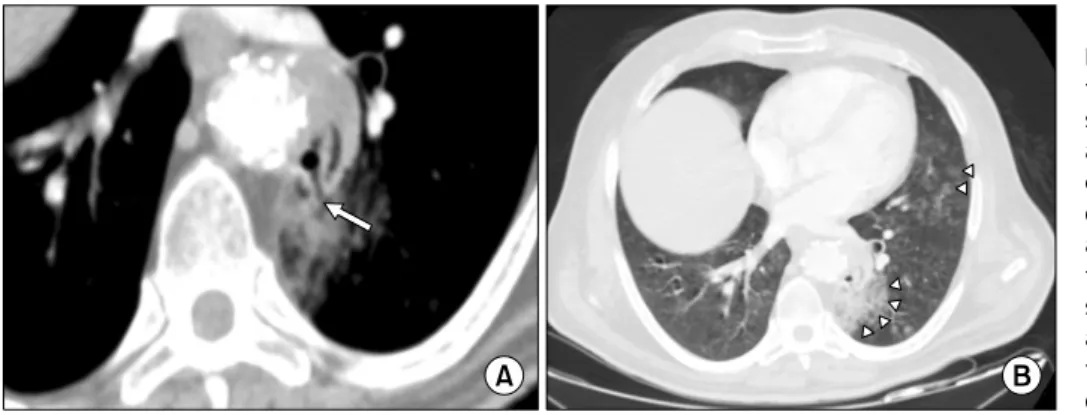 Fig. 2. Minimum intensity projec- projec-tion reformaprojec-tion (A) shows the  pre-sence of a significant proportion of  air in the aneurysmal sac with a  lin-ear air image with an interruption  of the aortic wall (arrow); (B) an  axial contrast-enhanced 