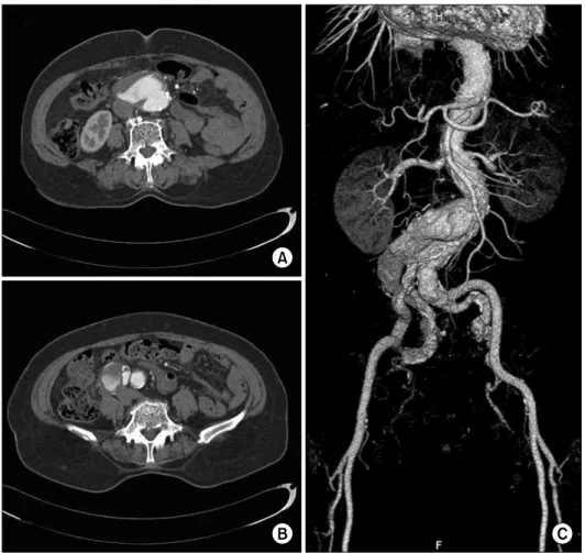 Fig. 1. Computed tomographic an- an-giography before endovascular  aort-ic repair. (A, B) Computed  tomo-graphic angiography shows the  in-frarenal abdominal aneurysm with  a maximum diameter of 50 mm and  the right common iliac artery  aneu-rysm with a ma